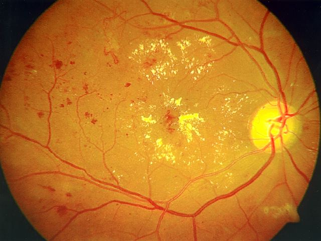 Glaucoma Services